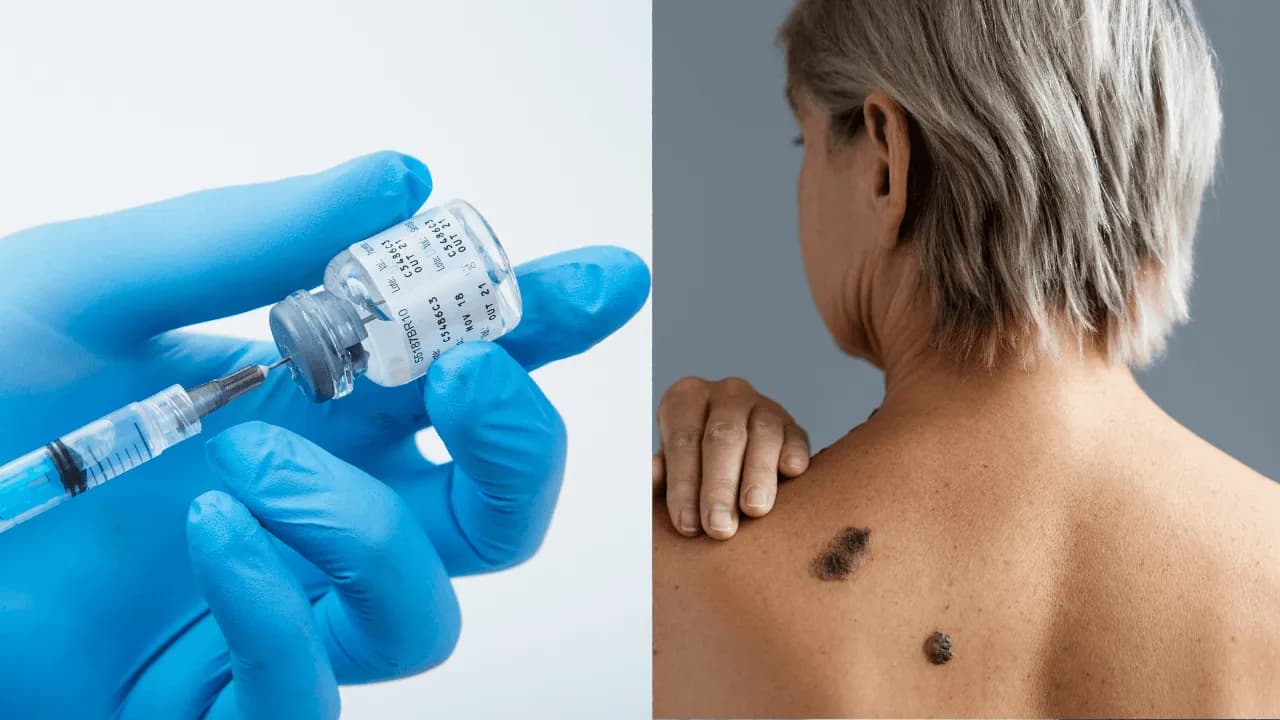 Una vacuna personalizada contra el melanoma supera una prueba clave en fase III: claves del esperanzador avance médico Una vacuna personalizada contra el melanoma supera una prueba clave en fase III: claves del esperanzador avance médico